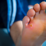 7 Penyakit Pada Telapak Kaki