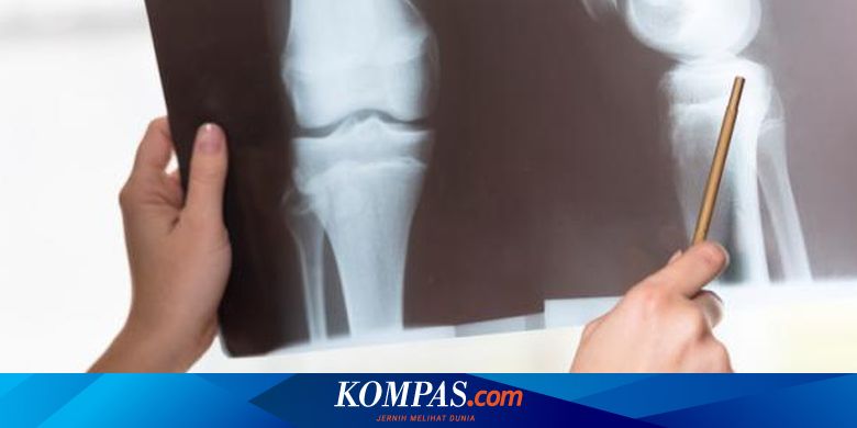 Apa Itu Osteoporosis Penyebab Dan Cara Mencegahnya