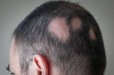Kenali Apa itu Alopecia Areata, Gejala, Penyebab, dan Faktor Risikonya