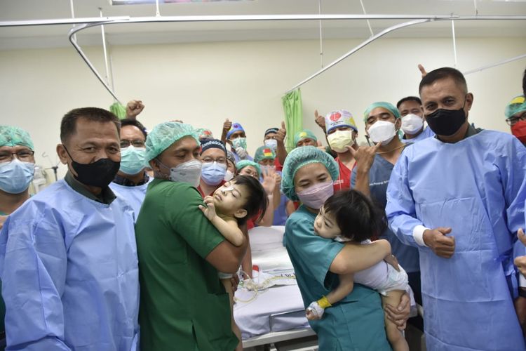 Tim dokter Rumah Sakit Umum Pusat (RSUP) Prof Kandou Manado, Sulawesi Utara berhasil memisahkan anak kembar siam bernama Joana dan Jovalin, Kamis (21/4/2022).