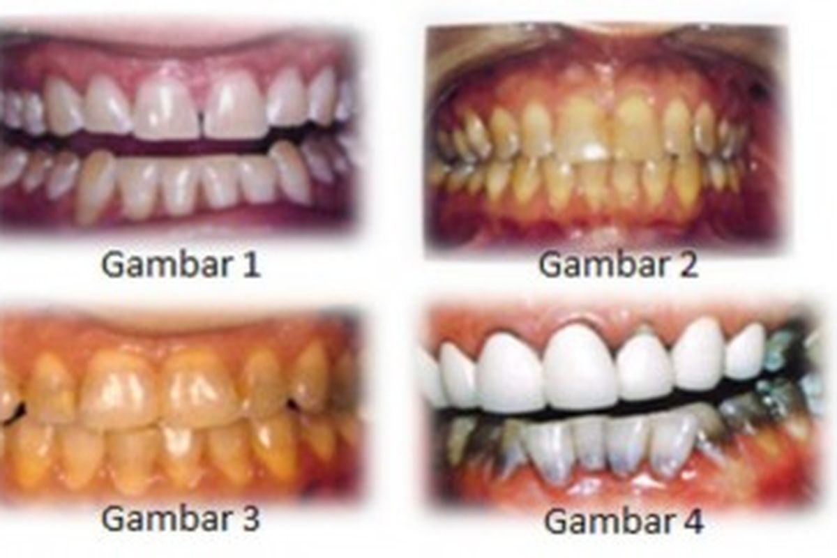 Perubahan warna gigi akibat tetrasiklin.