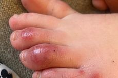 'Covid-Toes', Benarkah Ciri Virus Corona yang Muncul di Jari Kaki?