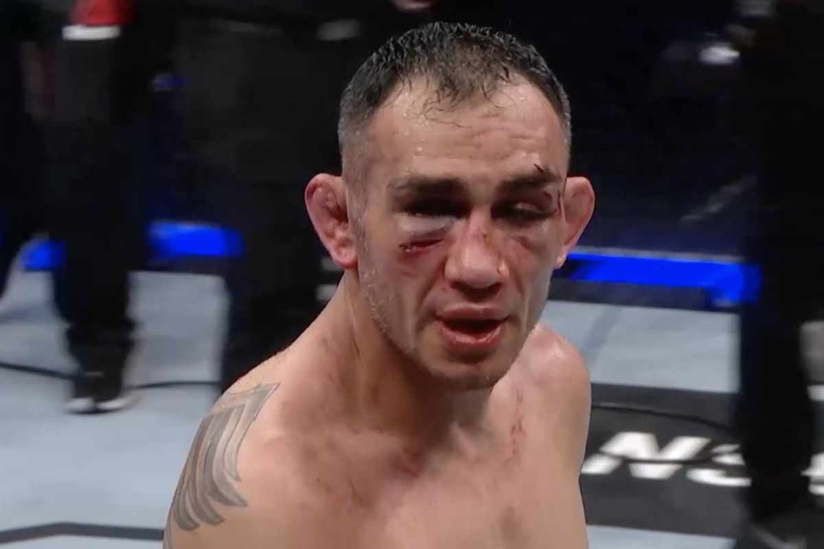 Luka-luka di muka Tony Ferguson setelah pertarungan menghadapi Justin Gaethje di UFC 249, Minggu (10/5/2020) pagi WIB.