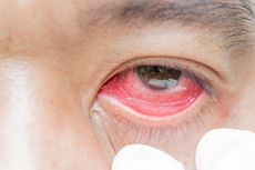 Peneliti: Mata Merah Bisa Jadi Gejala Covid-19, Waspadai Penularannya Melalui Air Mata 