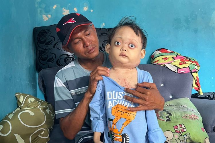 Kurnadi (41) menunjukkan kondisi anak keduanya, Vika Navadilla (5), yang menderita pembengkakan kelenjar getah bening atau limfadenopati di rumah mereka di Desa Rambatan Wetan, Kecamatan Lohbener, Kabupaten Indramayu, Jawa Barat, Minggu (7/9/2025).