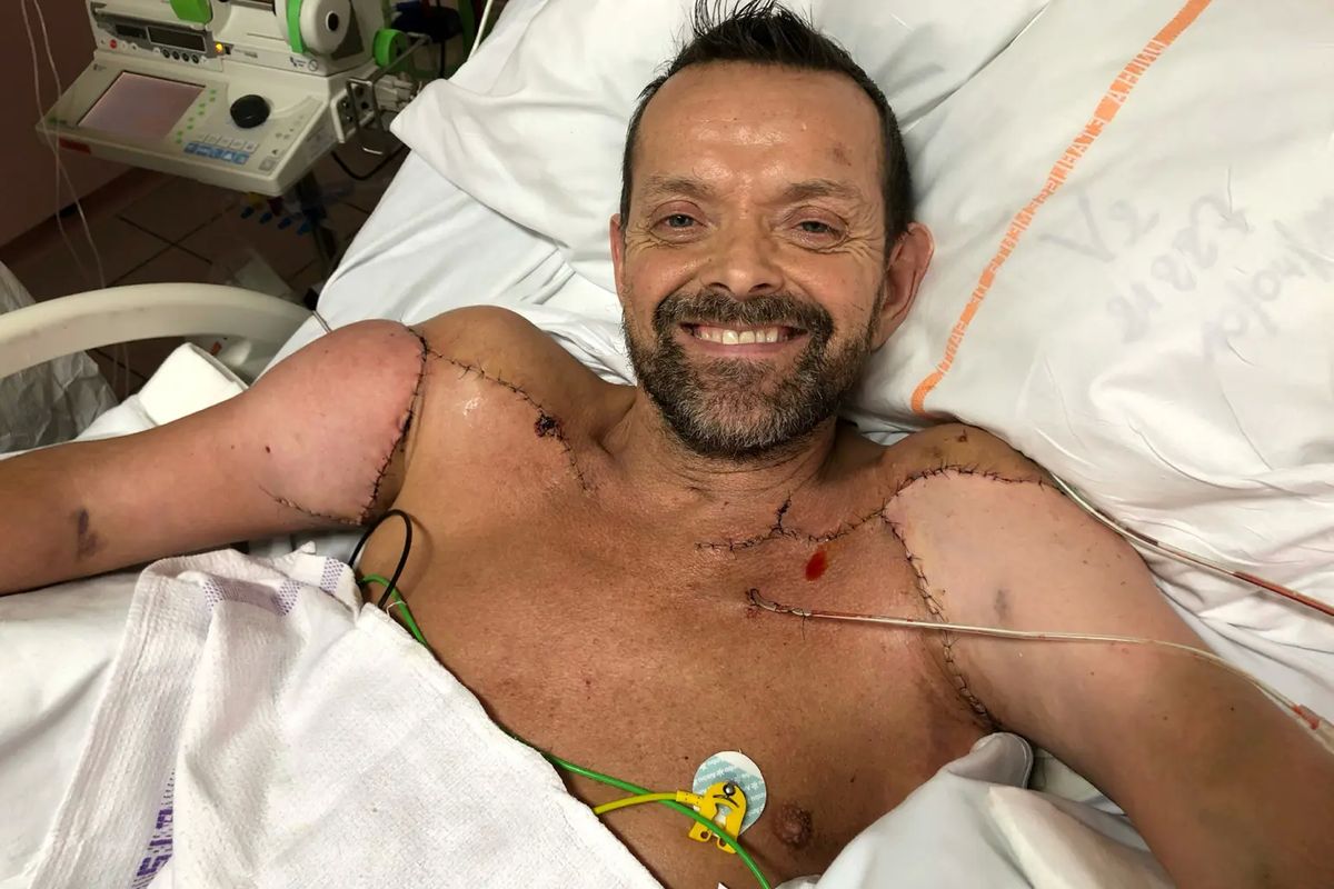 Felix Gretarsson pascaoperasi transplantasi kedua lengannya di Perancis tahun 2021 lalu.