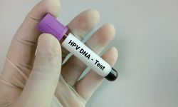 Kenali Tes HPV DNA untuk Mendeteksi Kanker Serviks dan Caranya