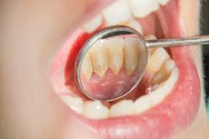 Penyebab Karang Gigi dan Macam-Macam Karang Gigi