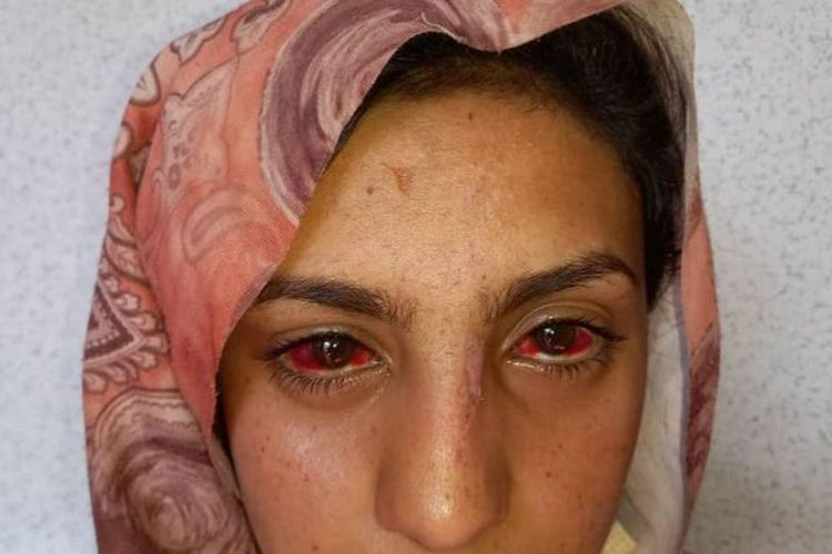 Seorang perempuan Afghanistan mengalami luka di kedua matanya akibat gempa, namun dia baru mendapat perawatan beberapa hari kemudian.