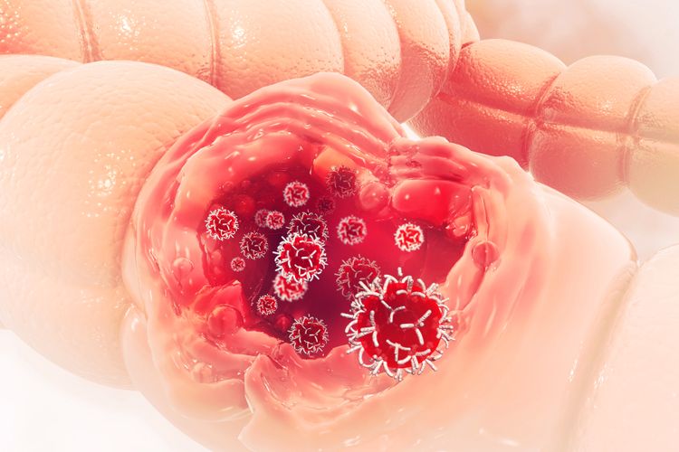 Ilustrasi kanker usus besar yang berpotensi menyerang orang dewasa usia muda. 
