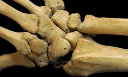 Bahan Kimia Abadi PFAS Bisa Ganggu Pertumbuhan Tulang Anak