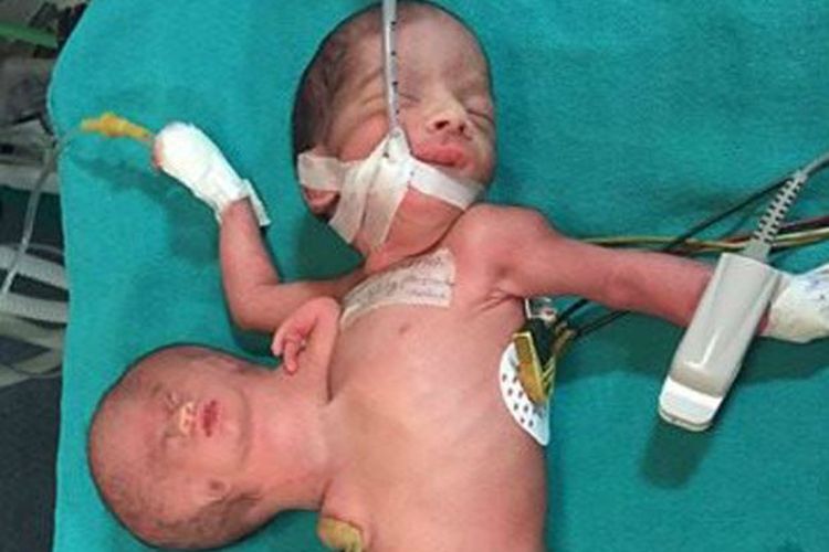 Bayi kembar parasit yang lahir di India, dengan kepala dan sebuah tangan kiri di dada.