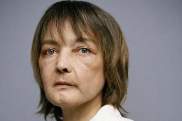 Isabelle Dinoire, wanita pertama di dunia yag menjalani transplantasi wajah.