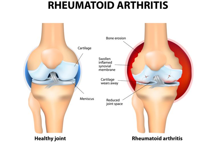 Ilustrasi Rheumatoid Arthritis