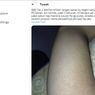 Ramai soal Bintik-bintik Hitam di Lengan Tangan dan Leher, Apa Itu?