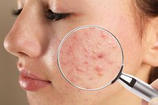 Jenis dan Urutan Skincare untuk Mengatasi Wajah Fungal Acne