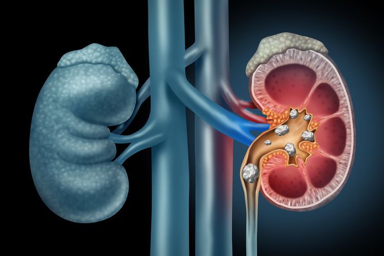 kidney stone illustration