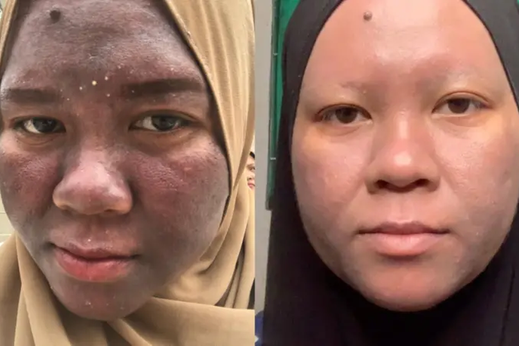 Wajah Nur Tya Gosong Usai Pakai Krim Wajah, Ini Ciri-ciri 