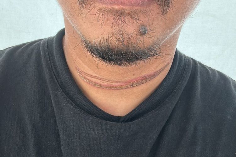 Caption: Luka yang dialami warga Cipinang Muara, Jatinegara, Jakarta Timur, bernama Dwi (35) saat lehernya terjerat kabel fiber optic ketika melintas di Jalan Raya Bogor, Kramatjati, Jakarta Timur, Sabtu (23/12/2023).