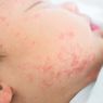 Alergi pada Bayi, Pahami Gejala dan Cara Perawatannya