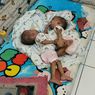 Rahman dan Rahim, Bayi Kembar Siam di Bekasi Meninggal Jelang Operasi Pemisahan