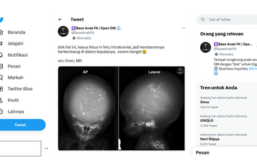 Tangkapan layar unggahan menyebut tentang fetus in fetu intrakranial