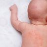 4 Penyebab Biang Keringat pada Bayi