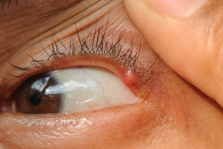 Bintitan adalah salah penyebab mata terasa mengganjal dan berair.