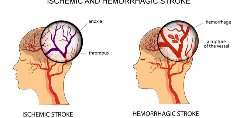 Penyakit Stroke Iskemik - Gejala, Penyebab, Pengobatan - Vimarsana News