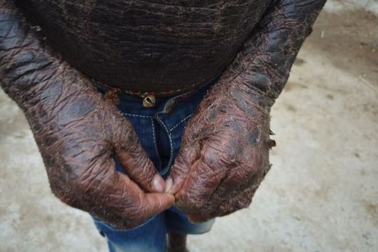 Bocah asal India mengalami kondisi langka, Lamellar ichthyosis, kelainan genetik langka pada kulit. Kondisi kulit bersisik ini membuatnya dijuluki sebagai manusia ular.