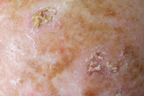 Actinic Keratosis