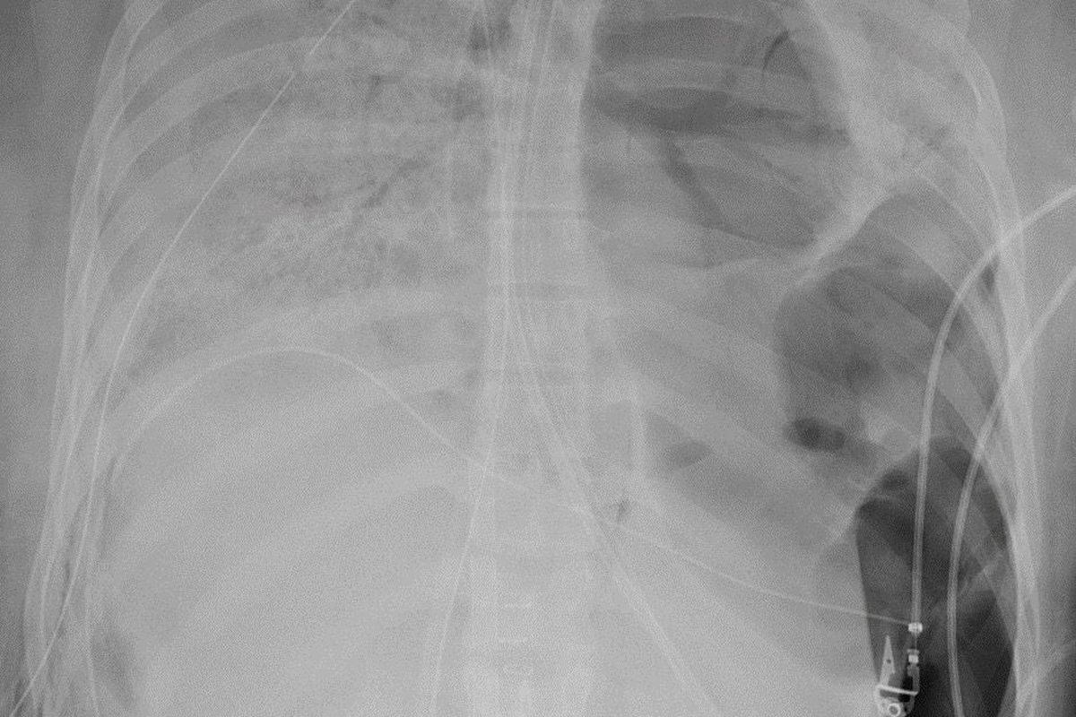 Rontgen paru-paru dari pasien Covid-19 sebelum menerima transplantasi paru-paru. FOto rontgen menunjukkan kerusakan parah pada paru-parunya.
