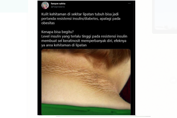 Tangkapan layar twit dari dr Furqon Satria soal ada lipatan menghitam yang terdapat di belakang leher.