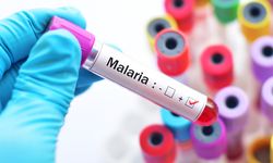 Gejala Malaria yang Perlu Diperhatikan Sebelum Terjadi Komplikasi