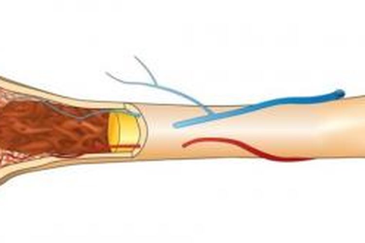 Penyakit Tulang Menjadi Rapuh Karena Kekurangan Vitamin D