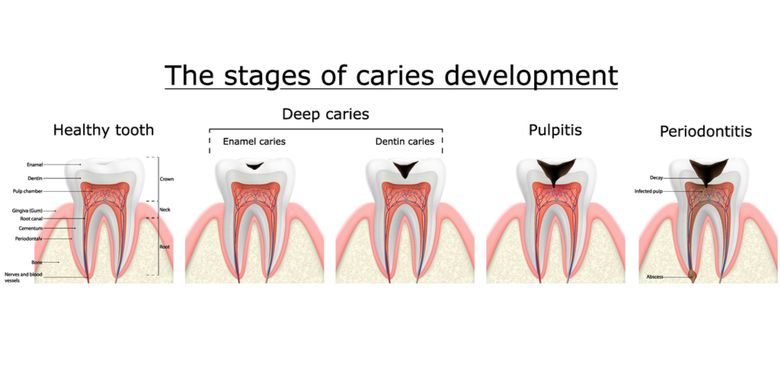 Ilustrasi tahapan karies gigi