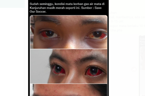 Viral, Foto Mata Merah Disebut akibat Terkena Gas Air Mata, Ini Kata Dokter