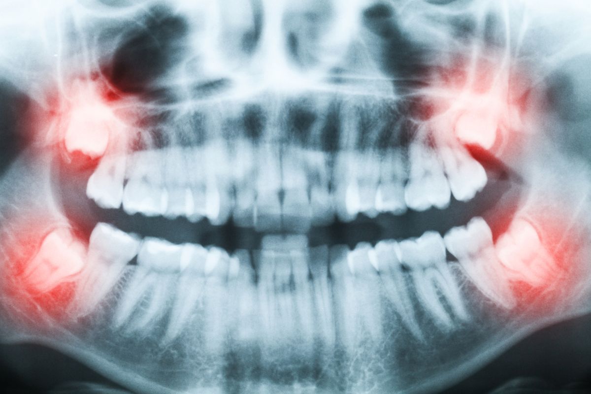 Ilustrasi gigi bungsu. Gigi bungsu adalah salah satu organ vestisial atau organ yang tidak diperlukan dalam tubuh manusia.