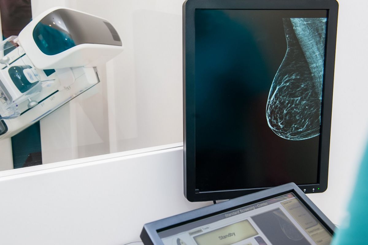 Ilustrasi tes mamografi untuk mendeteksi kanker payudara