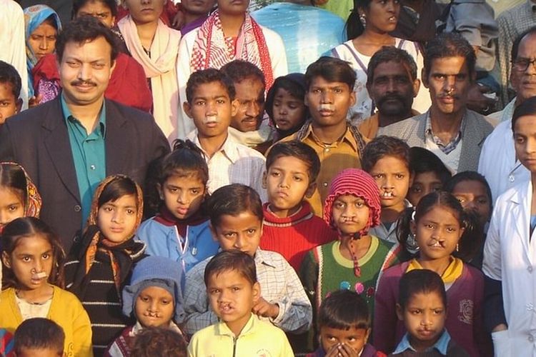 Dr. Subodh Kumar Singh (berdiri di kiri) bersama anak-anak di kamp yang menjalani operasi bibir sumbing.