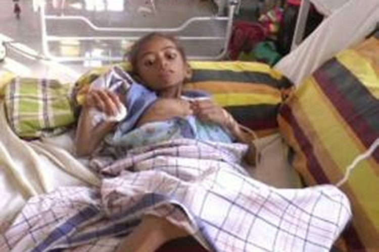 Rini (9) bocah asal Polewali Mandar ini menderita gizi buruk akut sehingga harus dirawat intensif di rumah sakit. 