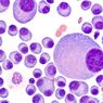 Kenali Apa Itu Multiple Myeloma, Penyebab, Gejala, dan Komplikasinya