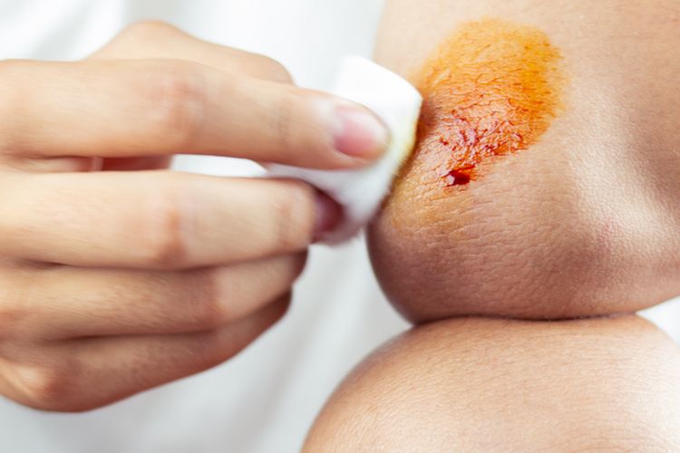 Ilustrasi luka, mengobati luka.