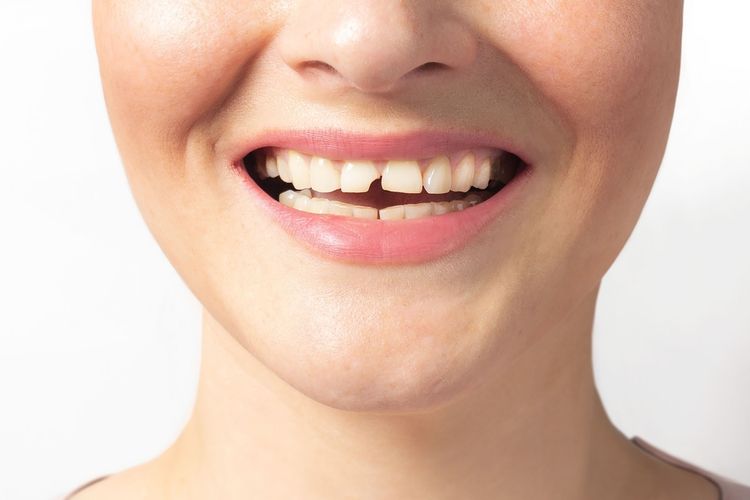 Salah satu penyebab gigi patah adalah kebiasaan menggemeretakkan gigi.