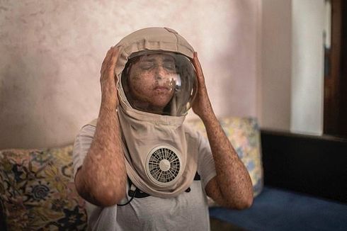 Sakit Kulit Langka, Gadis Ini Harus Pakai Helm Astronot Tiap Keluar Rumah