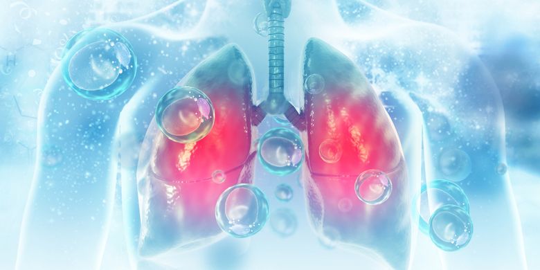 Ilustrasi CT scan dada (paru-paru) tunjukkan pneumonia, virus corona penyebab Covid-19.