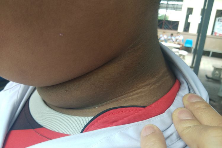 Benarkah Kulit Leher Menghitam Tanda Penyakit Diabetes? Ini Kata Dokter