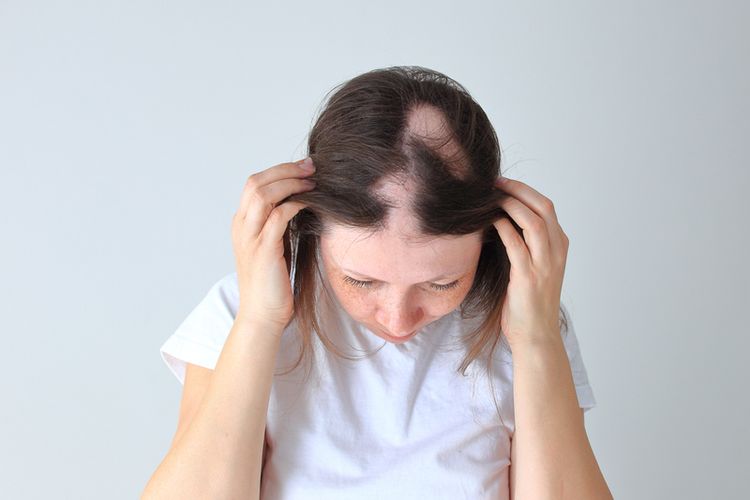 Alopecia areata tidak dapat disembuhkan. Namun, penderita alopecia areata dapat melakukan pengobatan atau perawatan agar kepala tidak botak dan rambut dapat tumbuh kembali. 