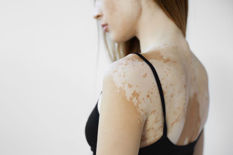 Ilustrasi vitiligo