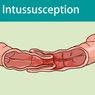 Intususepsi 
